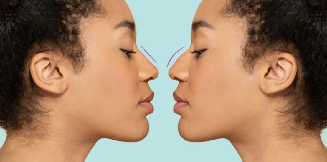 rhinoplastie ethnique