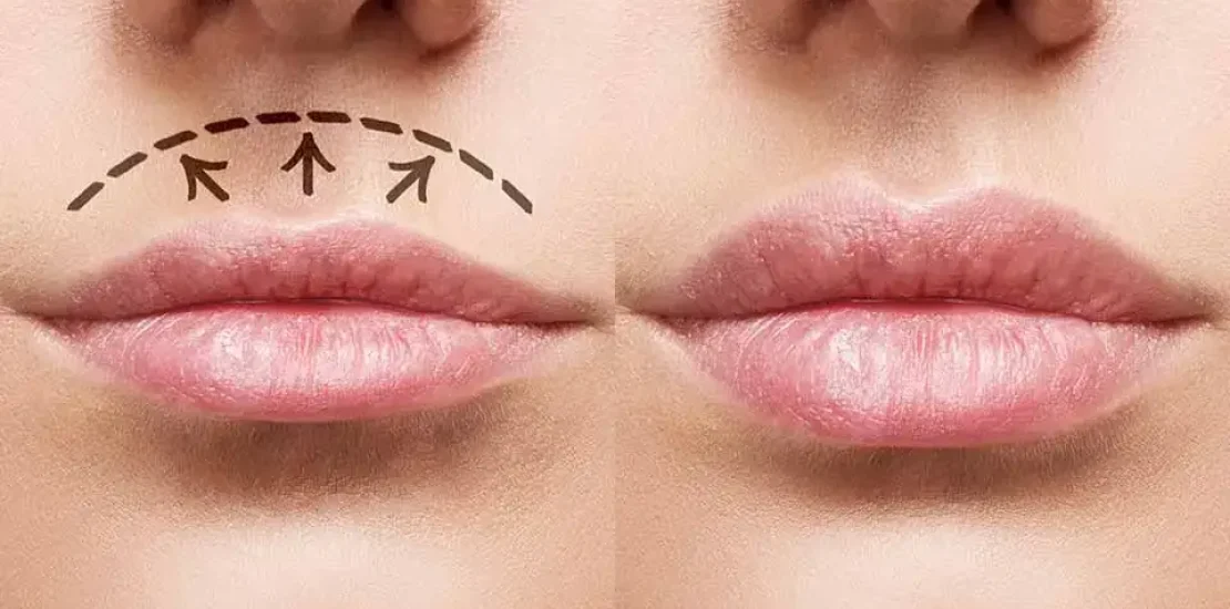 lifting des lèvres / Lip Lift