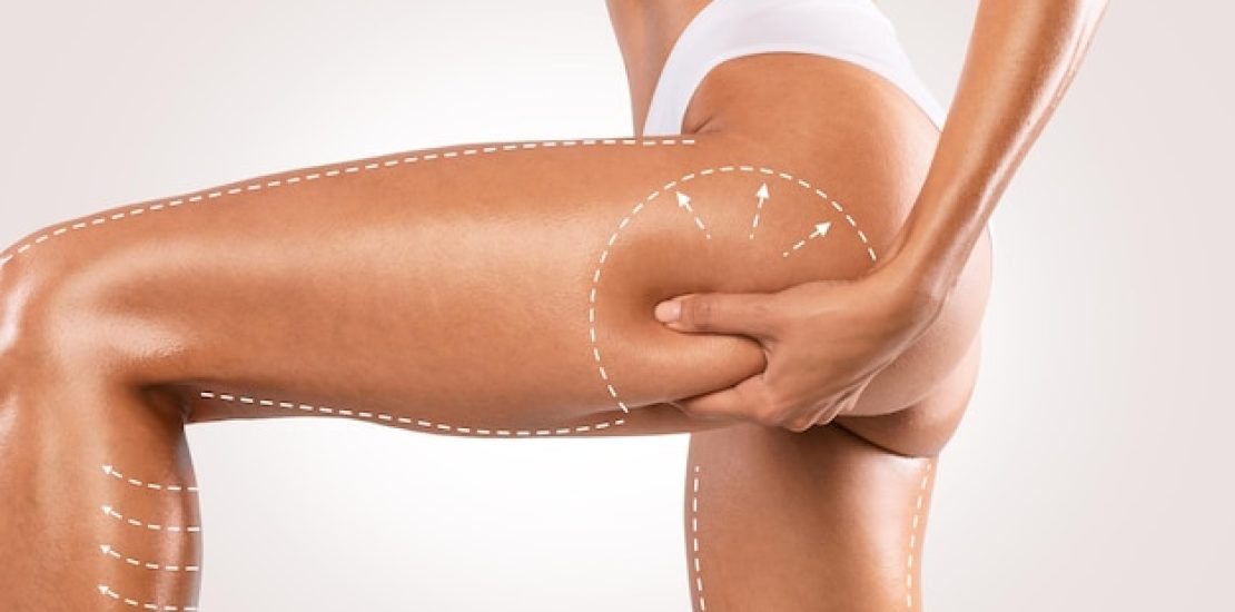 liposuccion-des-cuisses-prix-tunisie.jpg