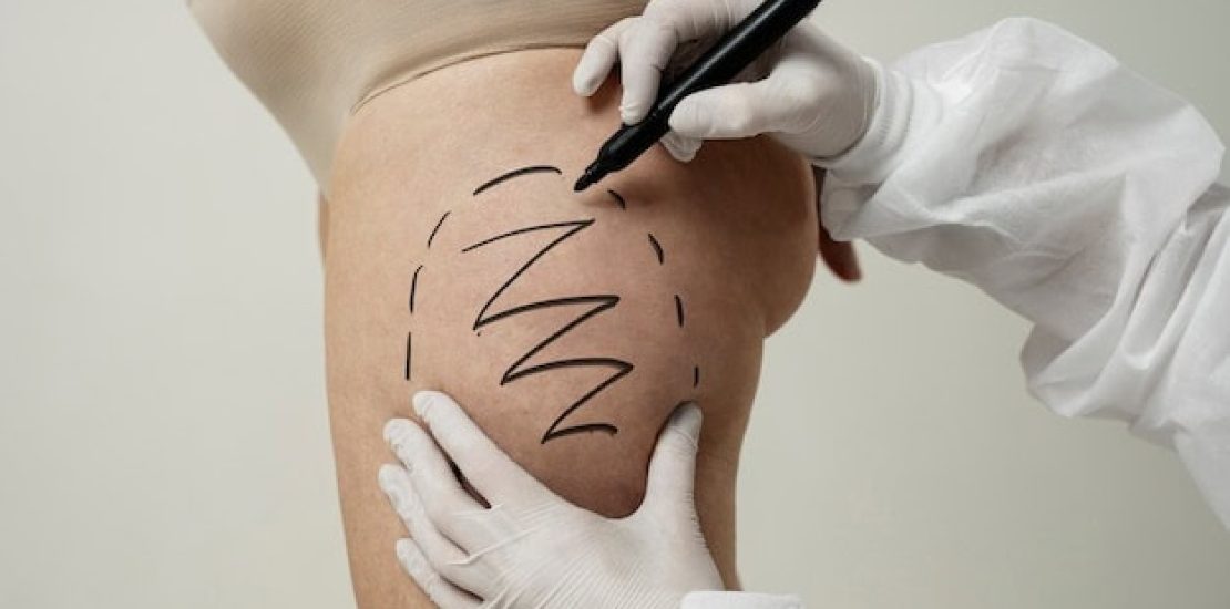 liposuccion-des-cuisses-prix-tunisie.jpg