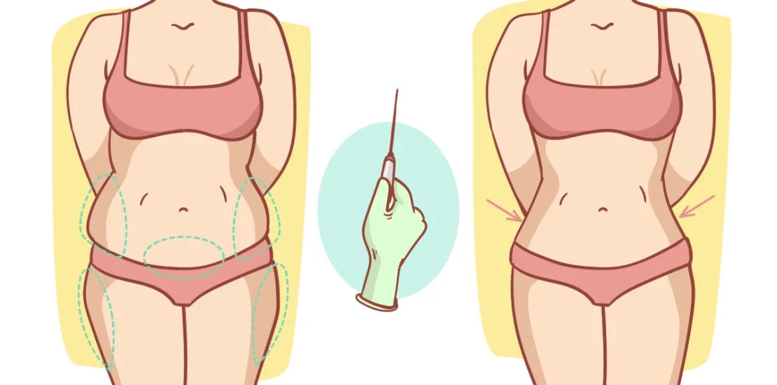 Liposuccion et liposculpture