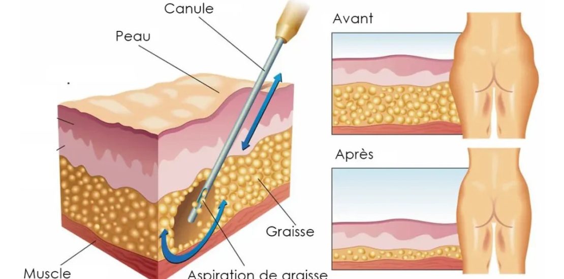 Schéma d’une liposuccion : aspiration de la graisse, avant et après