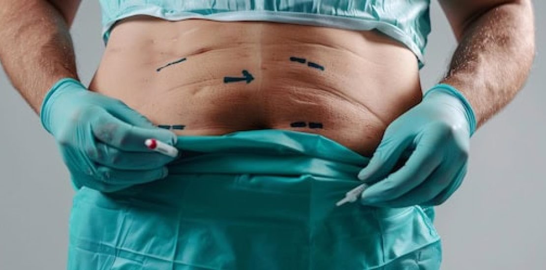 panniculectomy-surgery-tunisia-all-inclusive.jpg