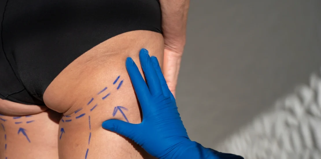 Pose d’implant fessier en Tunisie