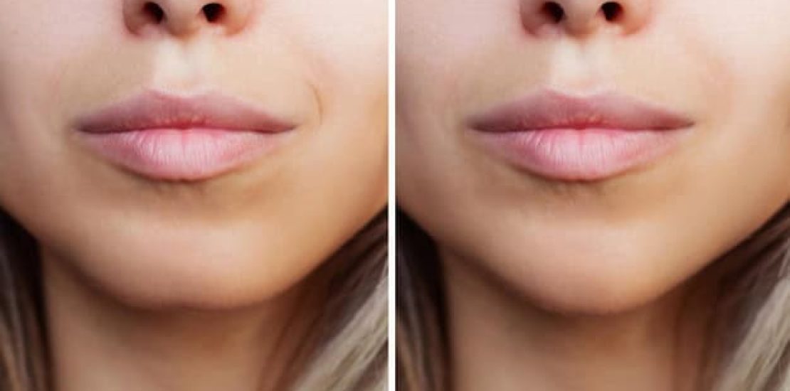 reduccion-labios-acido-hialuronico-tunez.jpg